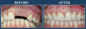 after implant