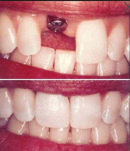 implant 1