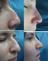 Nose Surgery Bala Cynwyd