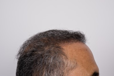 Hair Restoration Bala Cynwyd | Hair Restoration Philadelphia | Dr. Anthony  Farole, DMD