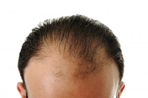 Bala Cynwyd Hair Restoration