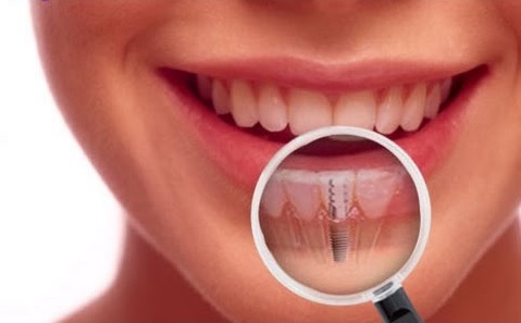 oral surgeon dental implants Bala Cynwyd, PA