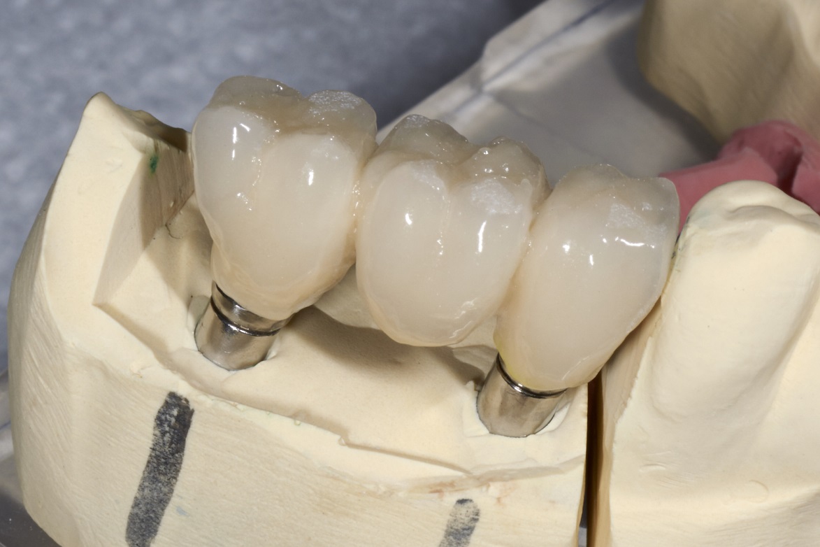 Dental Implants Bala Cynwyd, PA