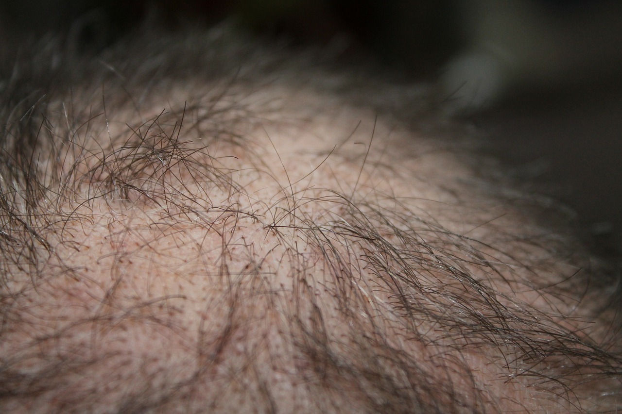 Hair Loss Treatment Bala Cynwyd