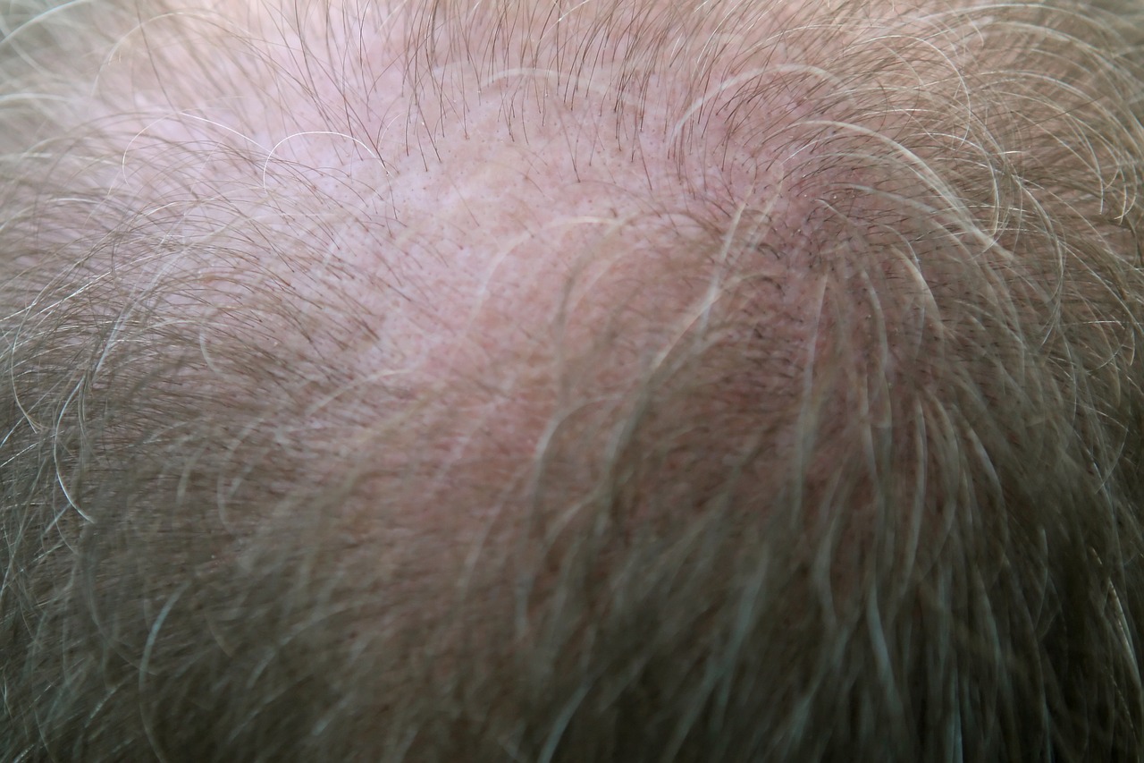 Hair Loss Treatment Bala Cynwyd