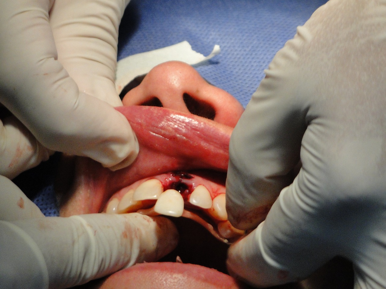 Teeth Implant Bala Cynwyd