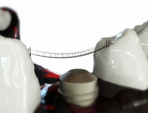 The Health Benefits of Dental Implants