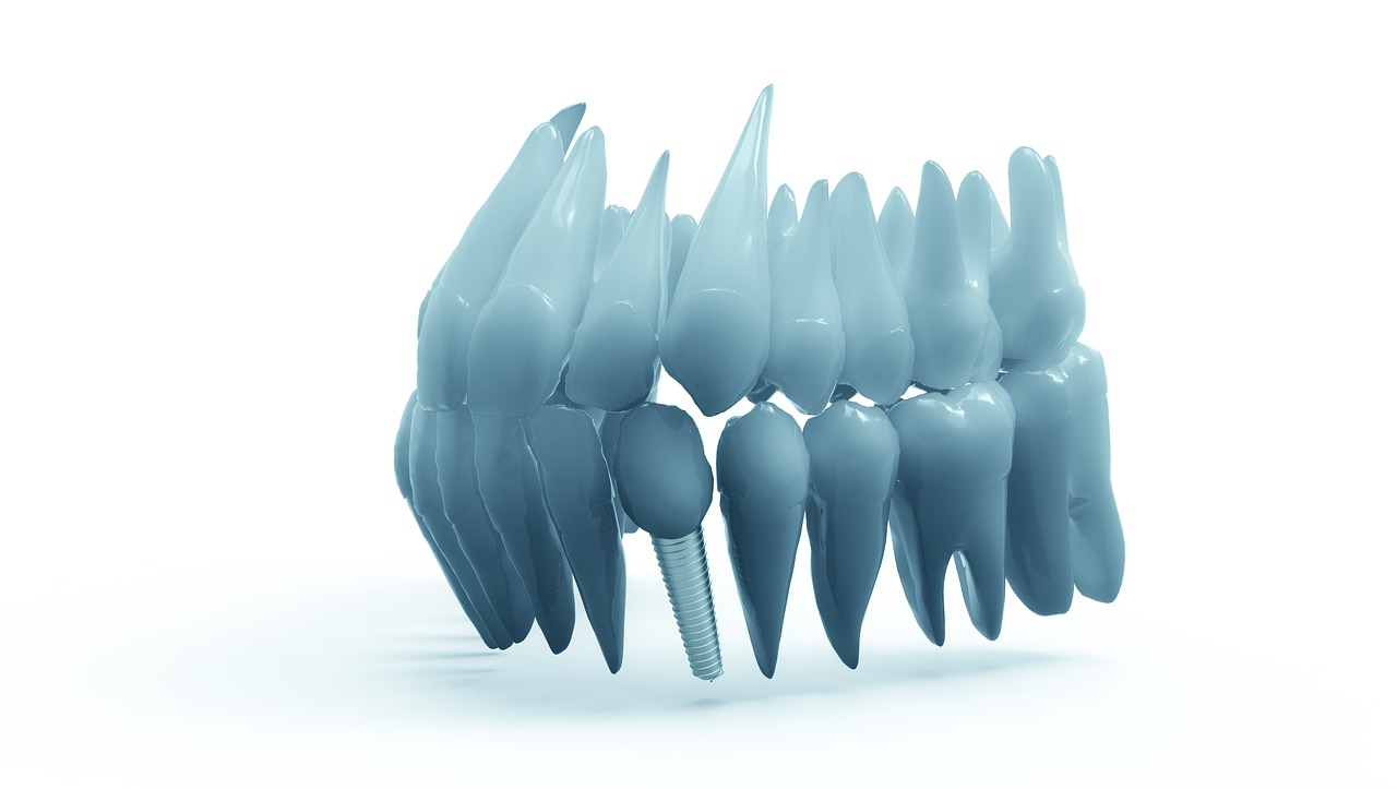 Dental Implants Bala Cynwyd, PA