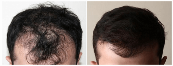 How Many People Lose Their Hair? Hair Loss Statistics | Dr Anthony Farole  DMD, Facial and Oral Surgery Center