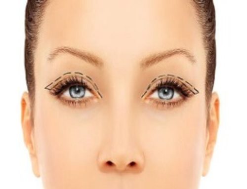 What is Blepharoplasty?